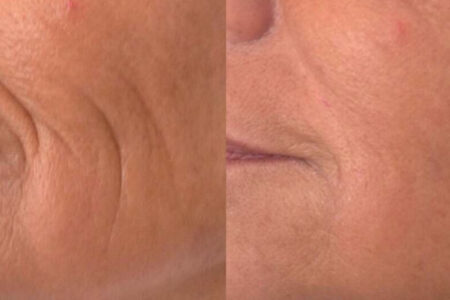 Fontona 4-D Non-Surgical Facelift