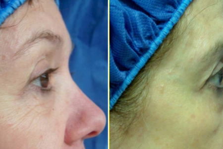 Fontona 4-D Non-Surgical Facelift