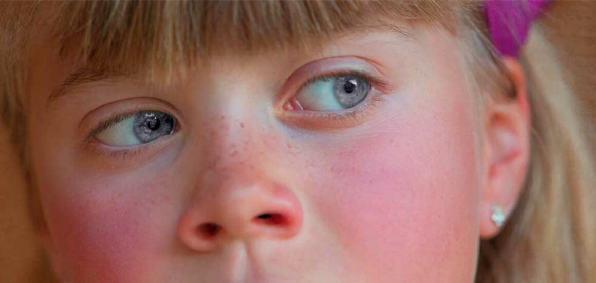 blog-image-rosacea