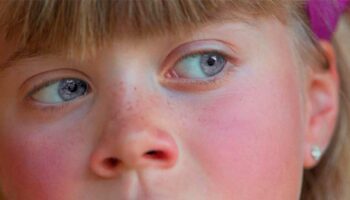 blog-image-rosacea