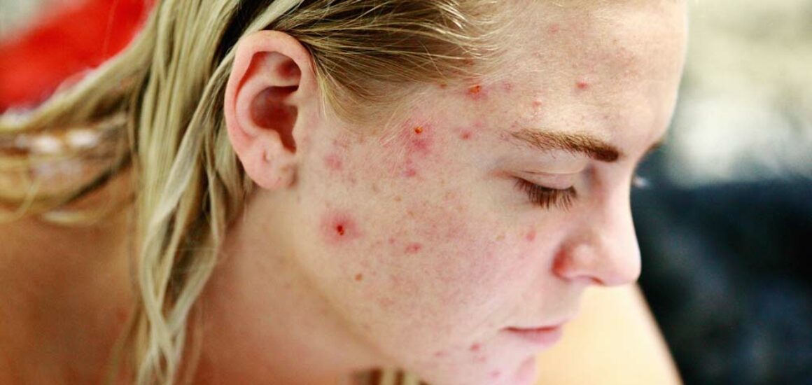 blog-image-acne-causes