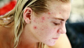 blog-image-acne-causes