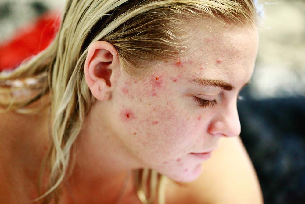 blog-image-acne-causes