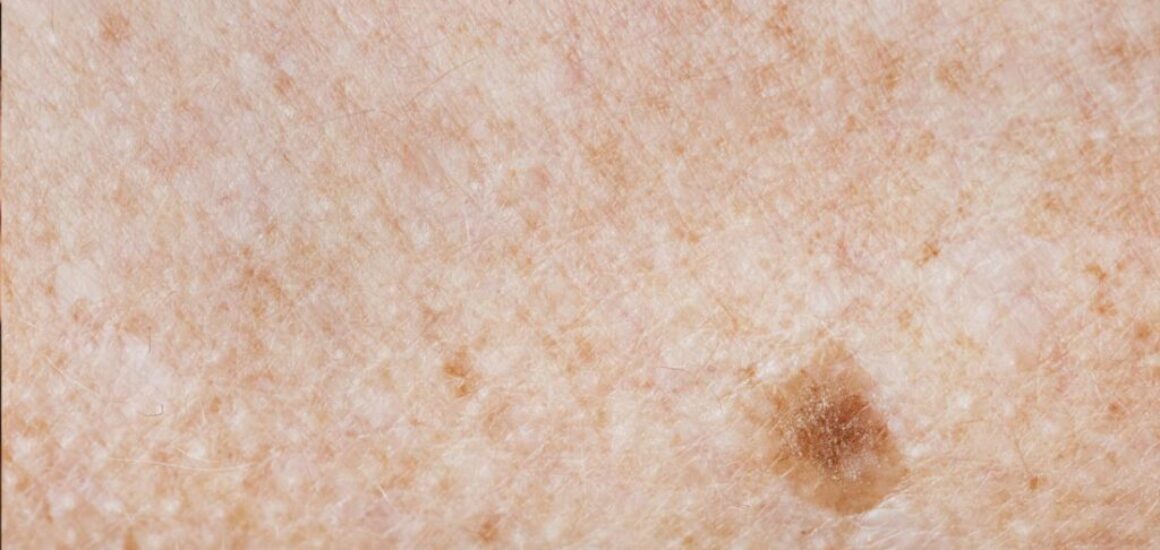 blog-image-nonmelanoma