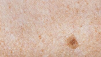 blog-image-nonmelanoma