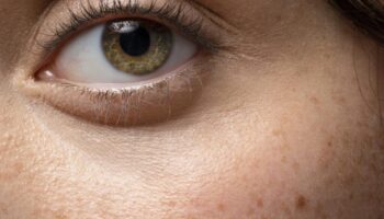 blog-image-hyperpigmentation-2022