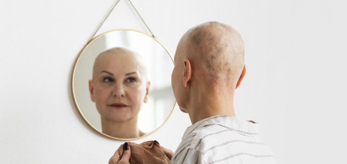 blog-image-alopecia-social