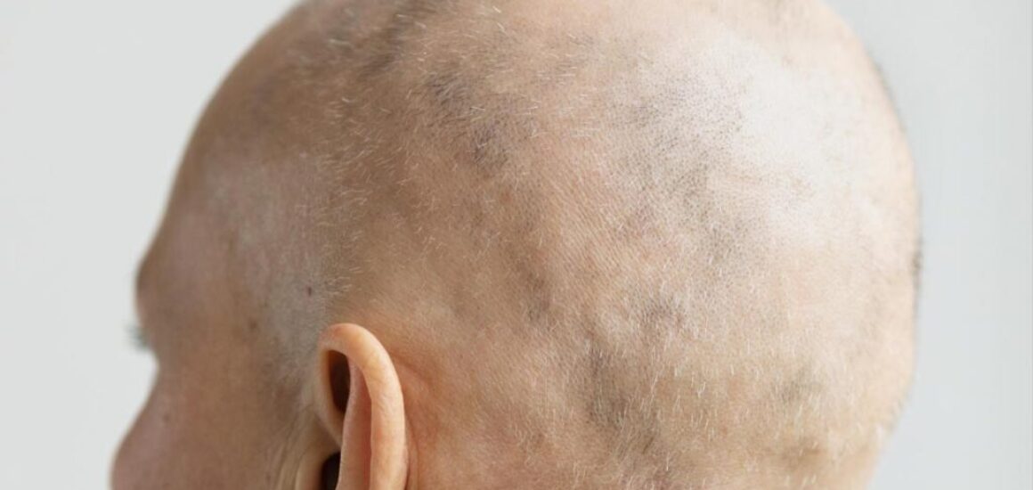 blog-image-alopecia-updates