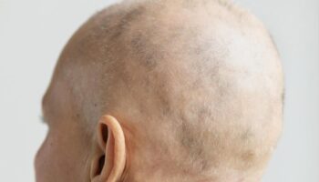 blog-image-alopecia-updates