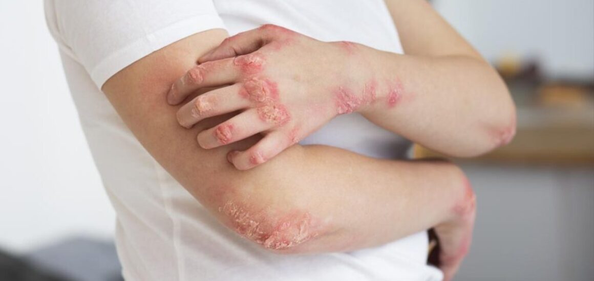 blog-image-eczema-4