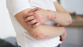 blog-image-eczema-4