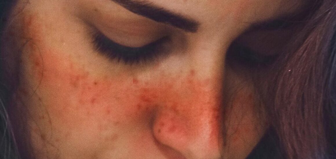 blog-image-lupus-rosacea