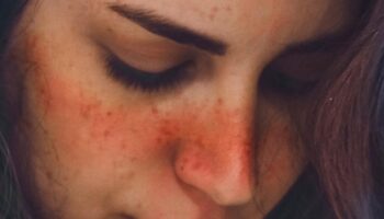 blog-image-lupus-rosacea