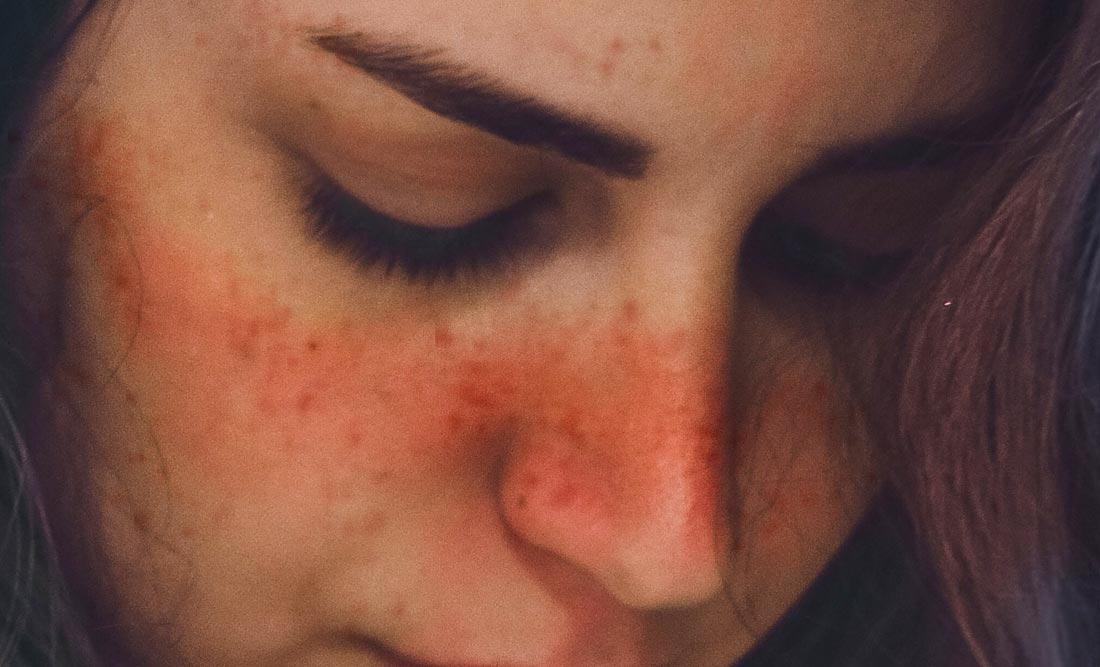 blog-image-lupus-rosacea