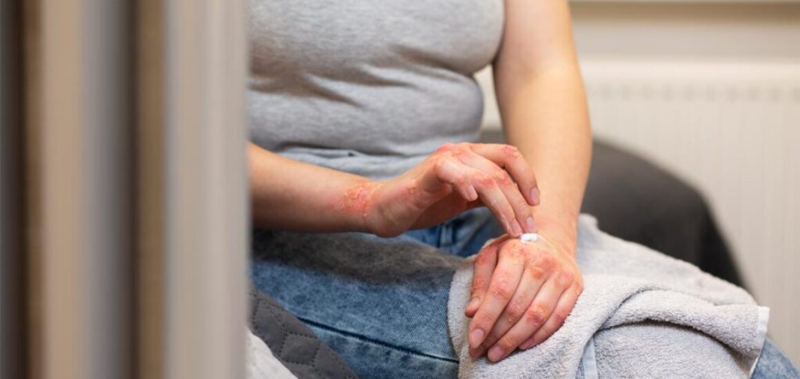 blog-image-psoriasis-2022