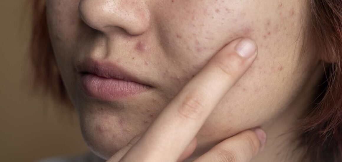 blog-image-chin-acne