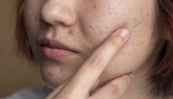 blog-image-chin-acne