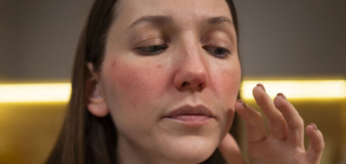 blog-image-four-types-rosacea