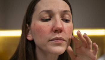 blog-image-four-types-rosacea