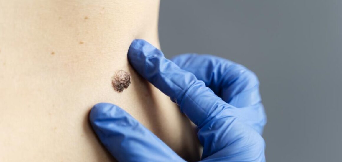 blog-image-melanoma-faccts