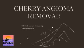 cherry angioma removal