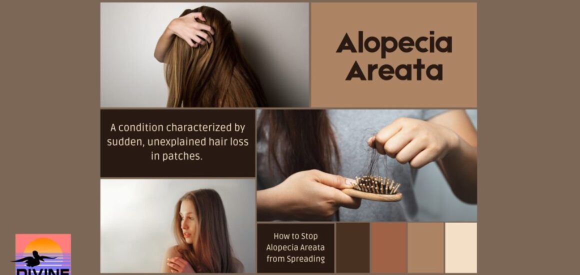 how to stop alopecia areata from spreading