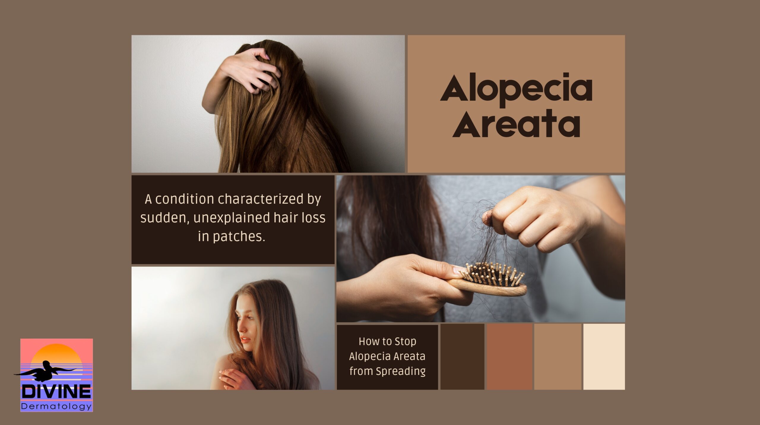 how to stop alopecia areata from spreading