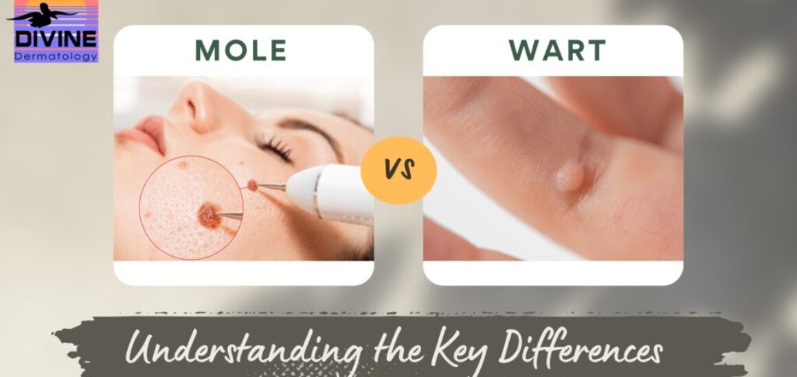 st pete dermatology wart vs mole