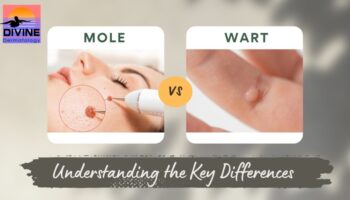 st pete dermatology wart vs mole