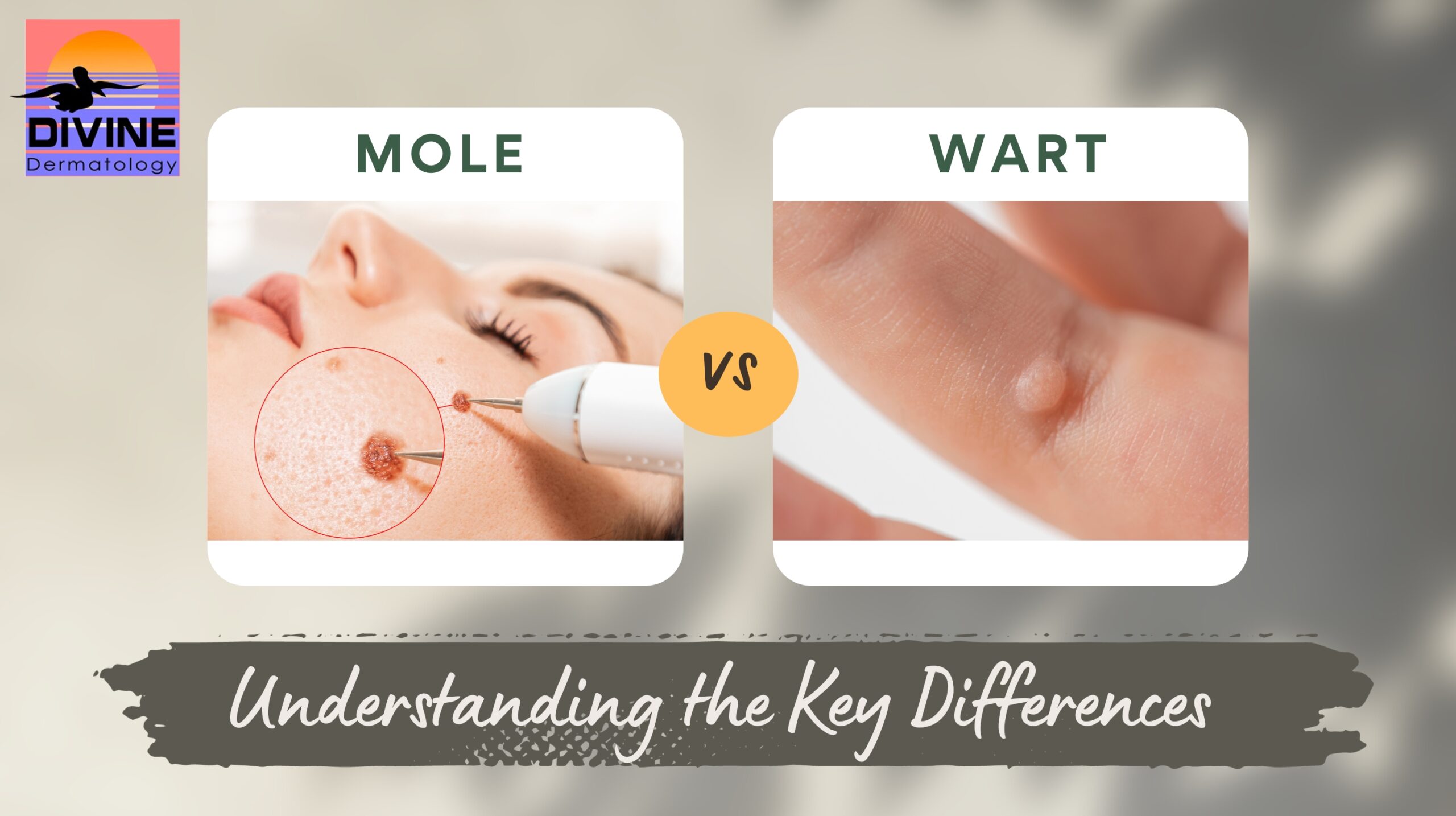 st pete dermatology wart vs mole