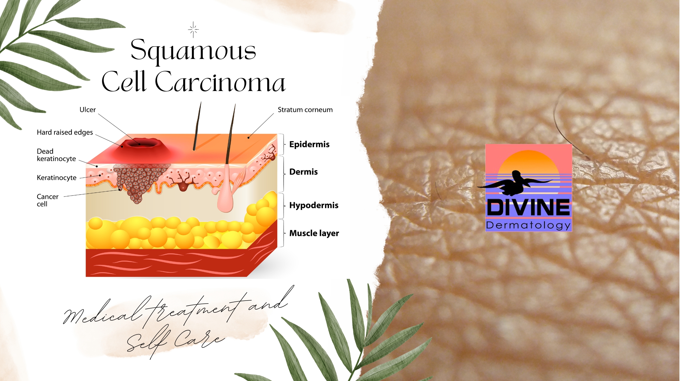 Squamous Cell Carcinoma