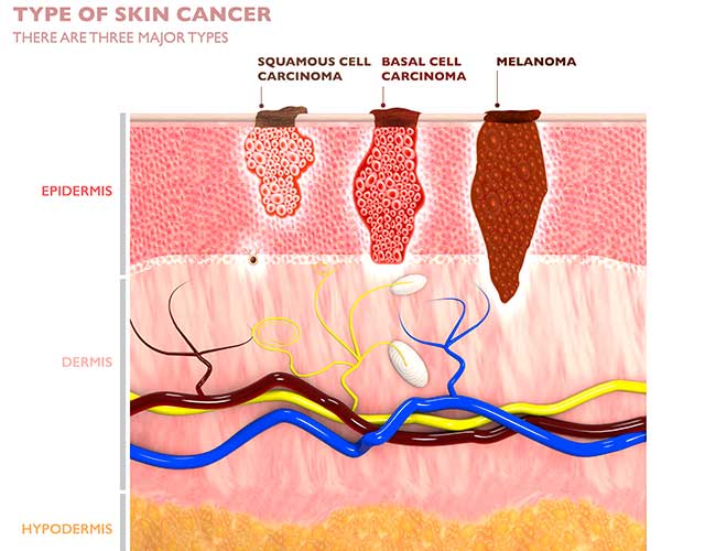 Squamous Cell Carcinoma