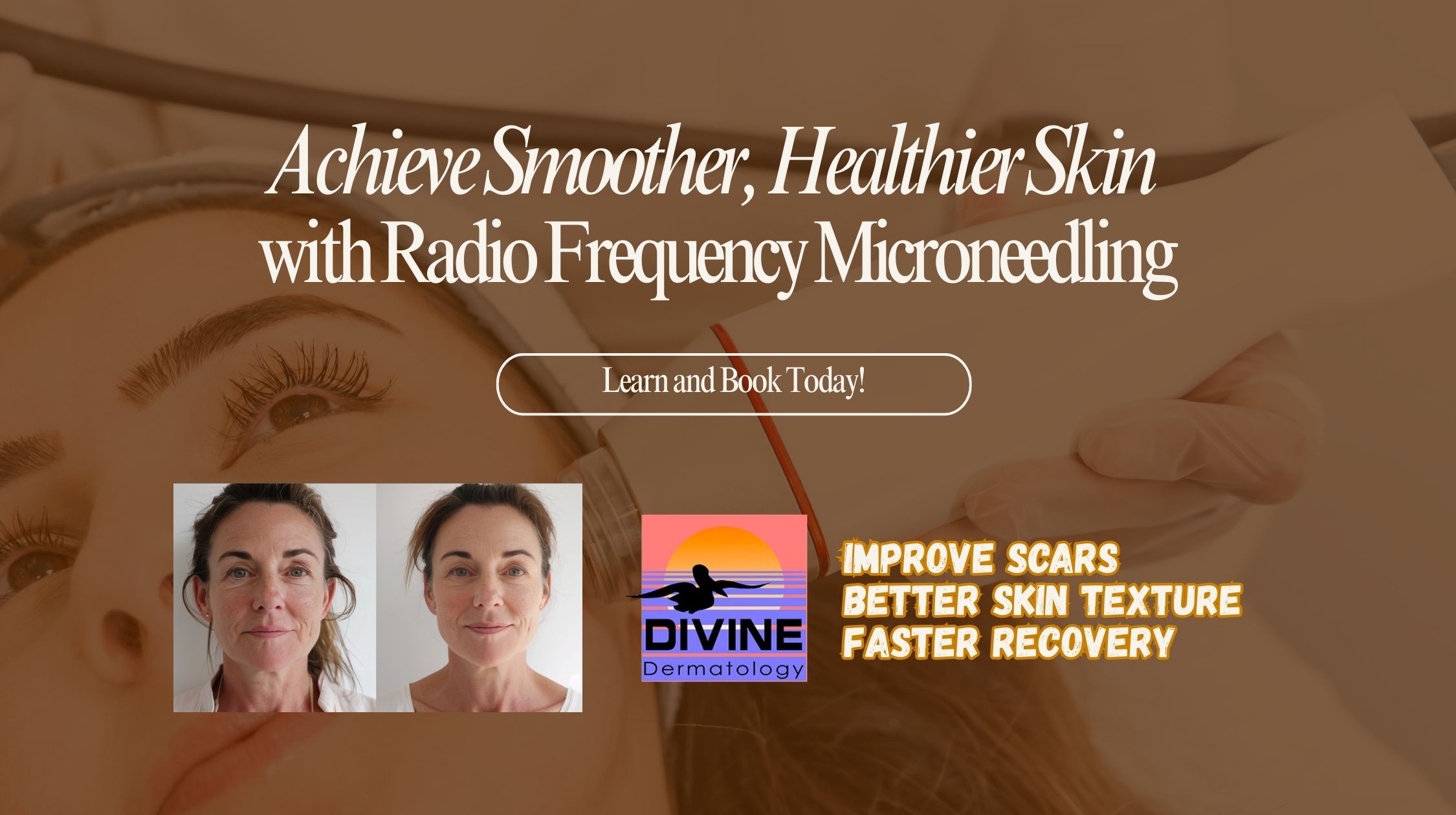 radio frequency microneedling, radio frequency microneedling near me, benefits of radio frequency microneedling