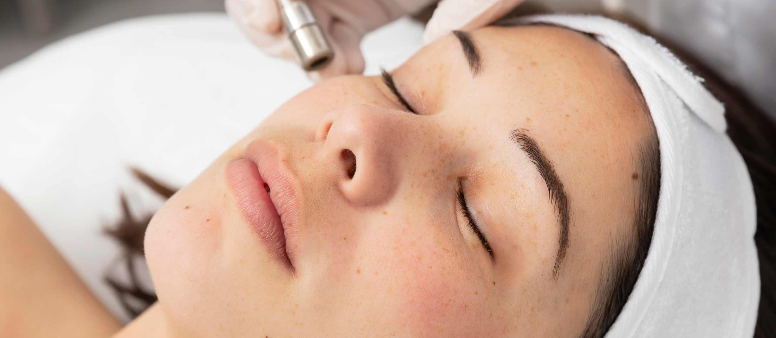 Get a FREE Chemical Peel with your Microneedling Package